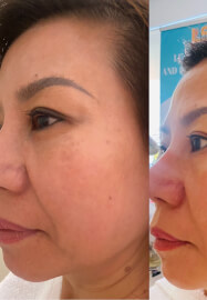 Facial Therapy Course